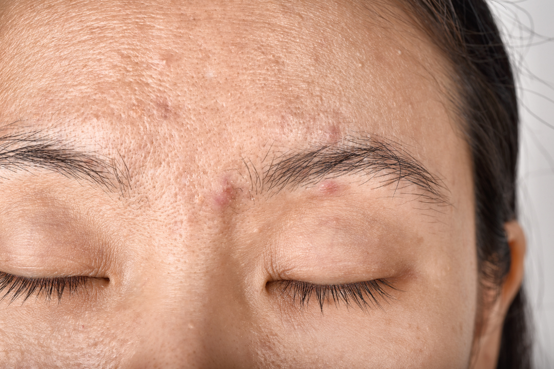 What Causes Premature Skin Aging, And How You Can Avoid It